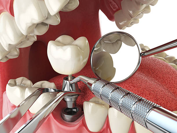 Best Dental Abscess Treatment in Union City, GA